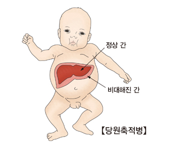 당원축적병