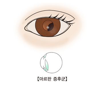 수정체탈구